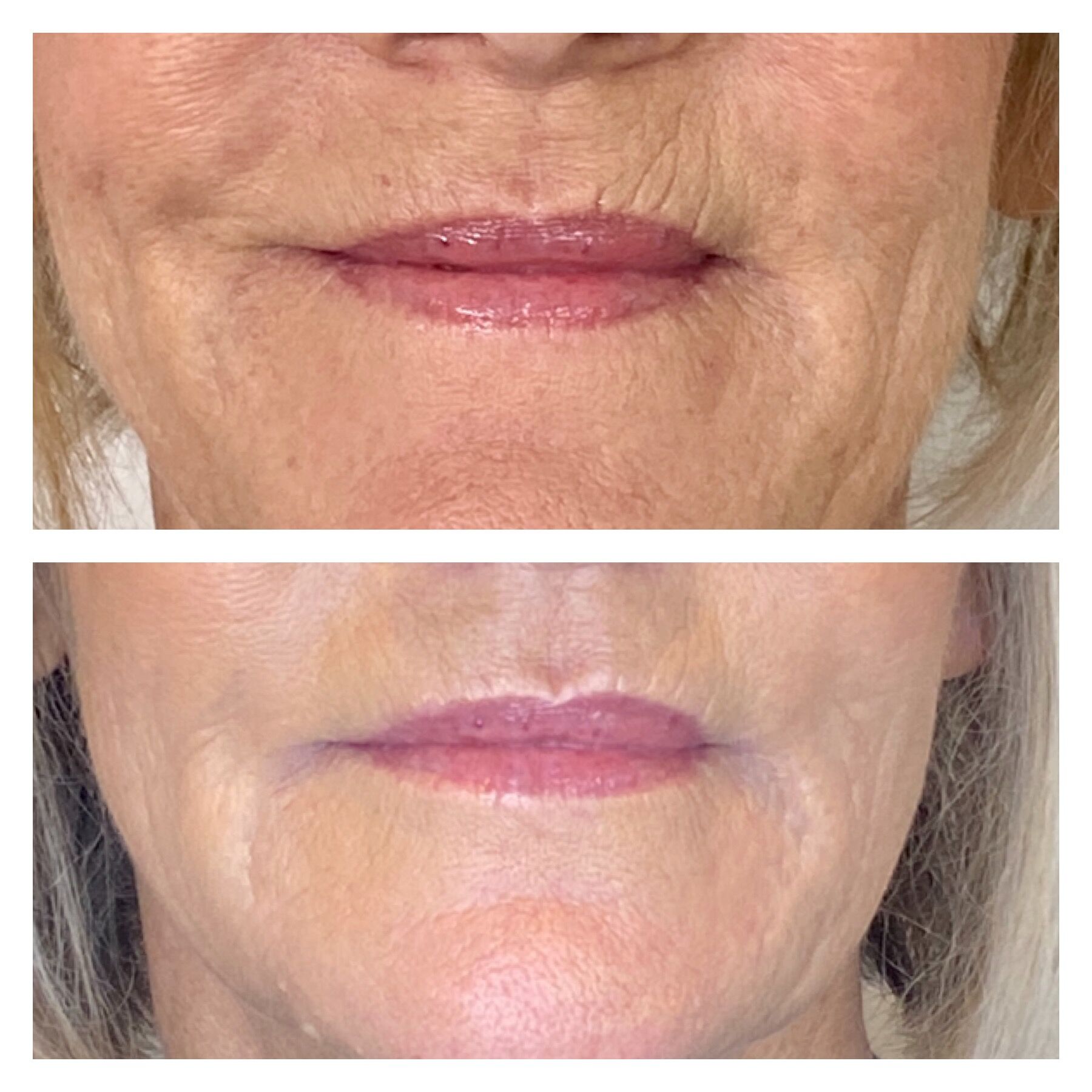temecula glutathione injections IV Drip Therapy Temecula: Personalized Treatments for Optimal Health What is Glutathione IV Used