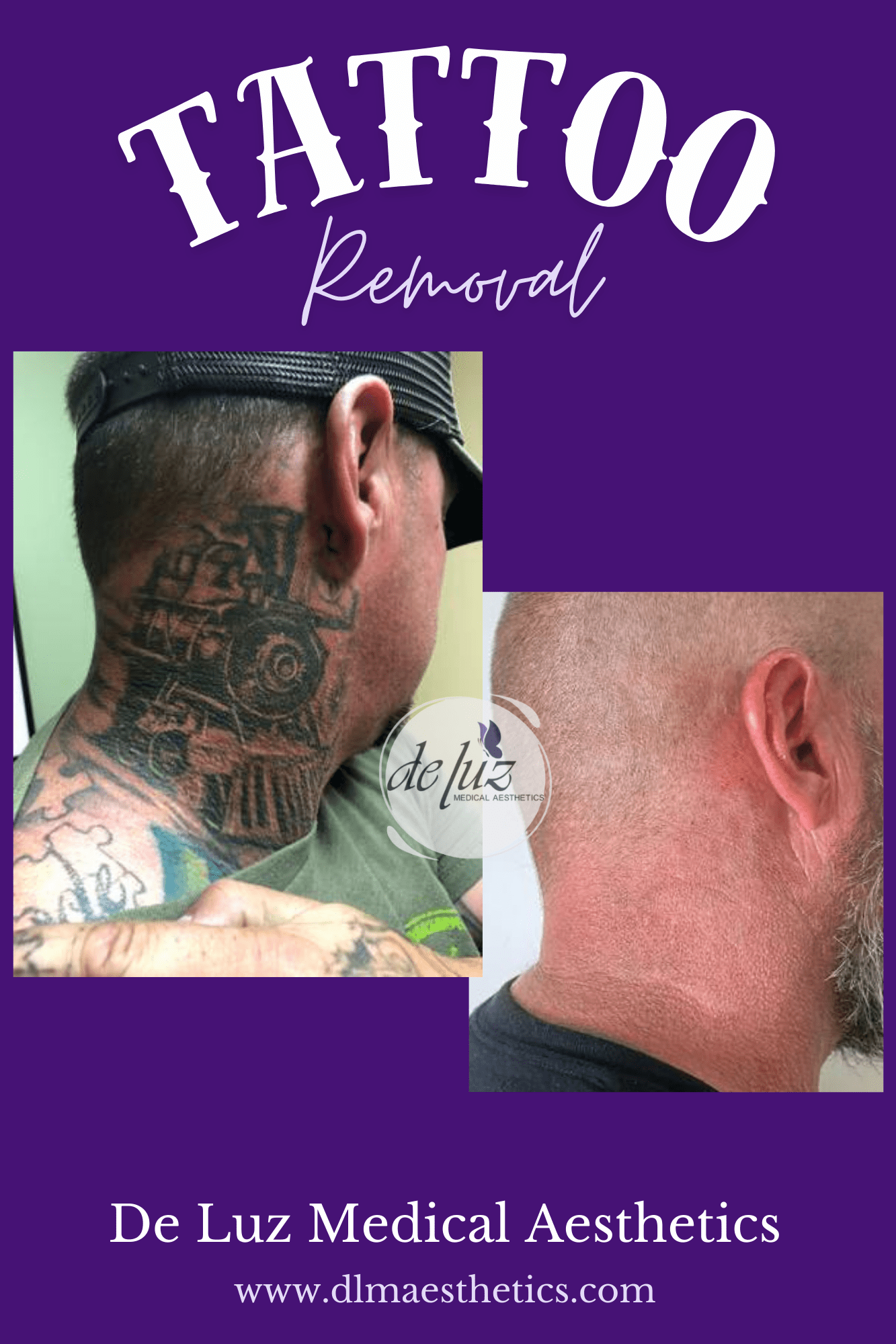 Tattoo Removal in Temecula