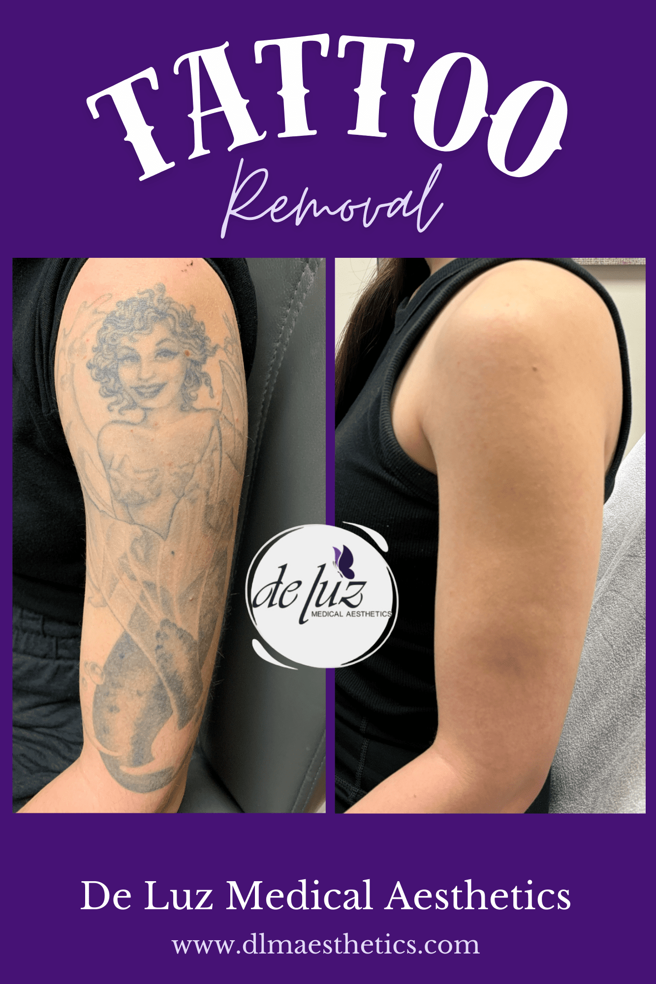Tattoo Removal in Temecula