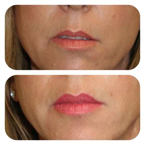 lip filler temecula