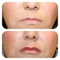 lip filler temecula