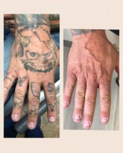 HAND-LASER-TATTOO-REMOVAL-IN-TEMECULA