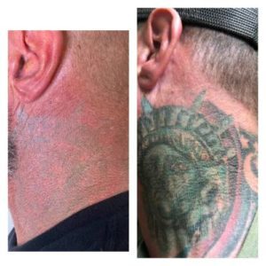 LASER-TATTOO-REMOVAL-TEMECULA