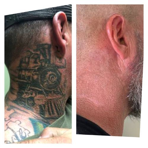 TEMECULA-TATTOO-REMOVAL