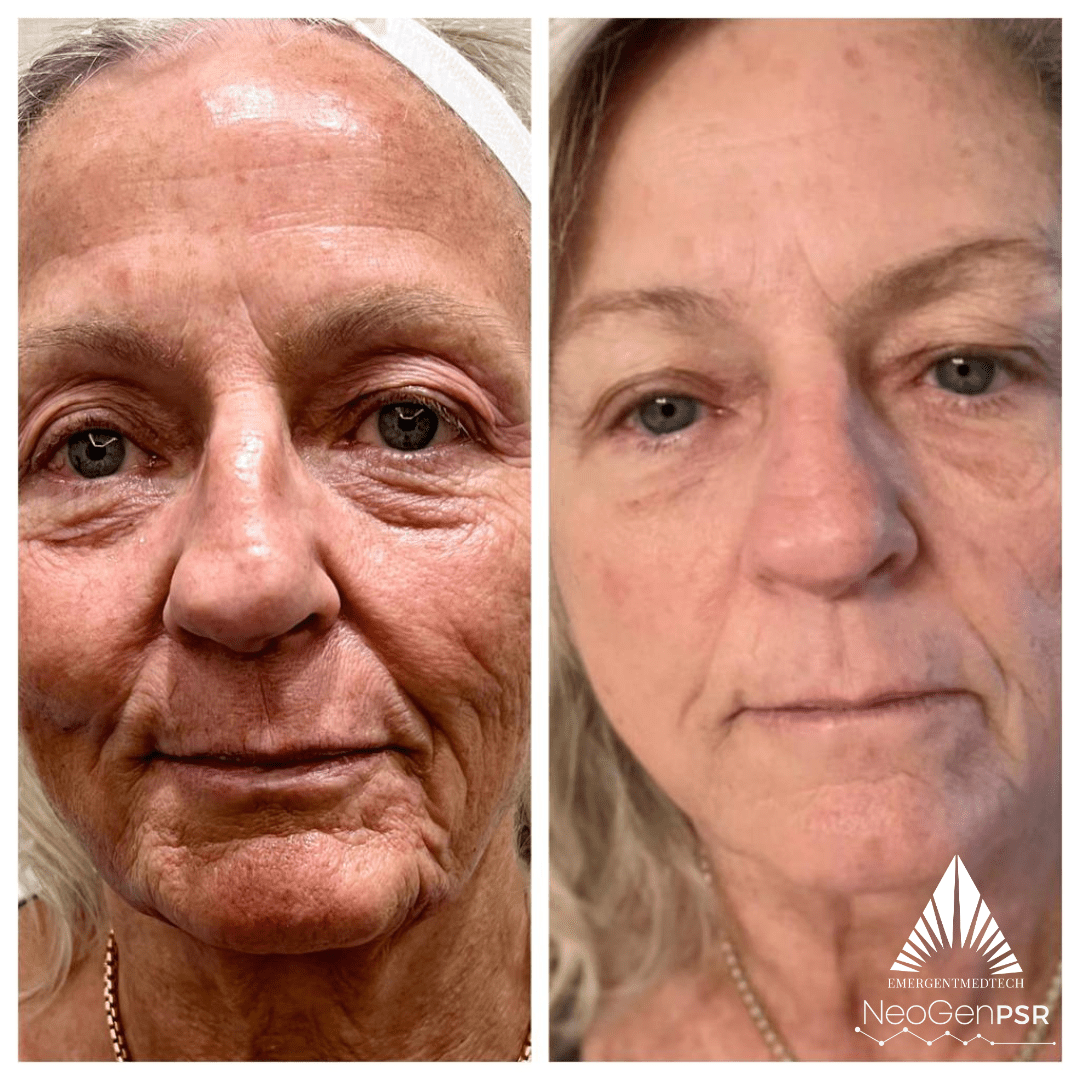 glutathione treatments in temecula ca NeoGen PSR – De Luz Medical Aesthetics Elixir Light Tube Cream