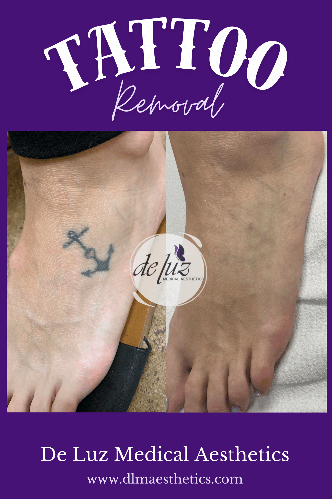 glutathione tattoo removal Tattoo Removal in Temecula